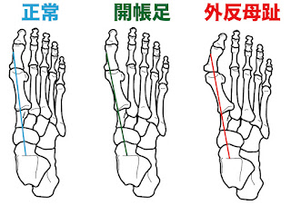 外反母趾で足指が開くメカニズムのイラスト。詳細は後述。