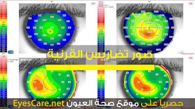 درجة تحدب القرنية, قراءات تحدب القرنية, تضاريس القرنية, موقع صحة العيون