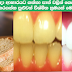 Teeth Whitening At Home 