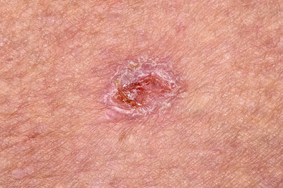 basal cell carcinoma : causes, symptoms and treatment