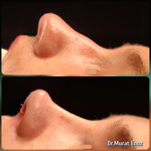 Rhinoplasty in Istanbul, Nose job, Nose aesthetic surgery