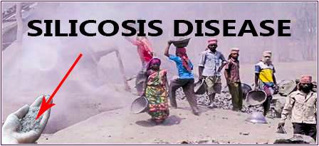 silicosis disease image