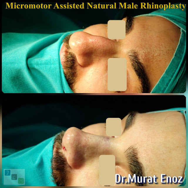 crooked nose job, twisted nose aesthetic,Asymmetric nose operation,Rhinoplasty For Men Istanbul,Micro-Motor Assisted Rhinoplasty Operation Istanbul,