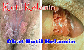 kutil kelamin