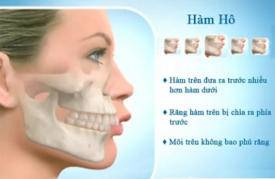 Trường hợp nào nên phẫu thuật hàm hô