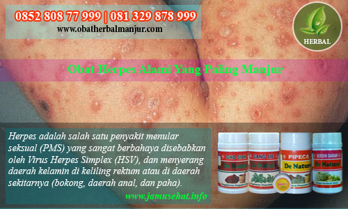 obat herpes simplex