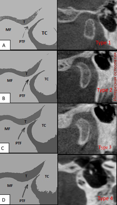 Варианты строения каменисто-барабанной щели. PTF - каменисто-барабанная щель, petrotympanic-fissure, T - височная кость, MF - нижнечелюстная ямка, TC - барабанная полость