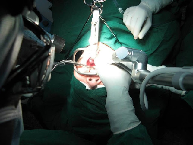 Phẫu thuật viêm họng hạt