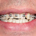 Quy trình niềng răng móm tại nha khoa