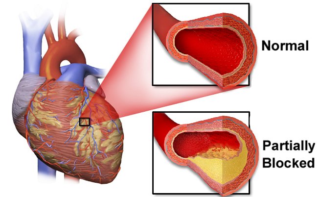 16+ Gambar Jantung Koroner, Yang Terbaru!