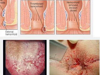 OBAT HERBAL PENYAKIT WASIR PALING AMPUH SEMBUHKAN TANPA OPERASI