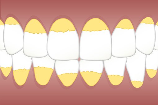 Sarro dental: ¿Qué es y por qué se produce?