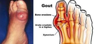 Understanding And Medicine of Urid Acid