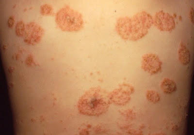 Dermatitis Numular – Penyebab, Gejala, Dan Cara Mengatasi