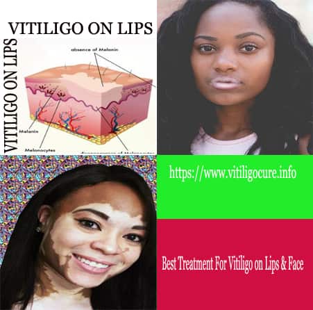 What Is The Best Treatment For Vitiligo On Lips Face