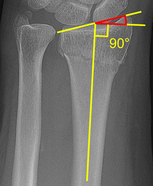 Radial Fracture Treatment | Radial Bone Fracture Surgery