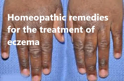 homeopathic remedies for eczema