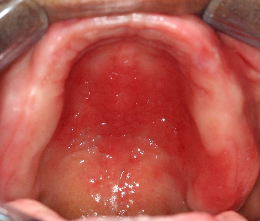 Estomatitis Subprotesica