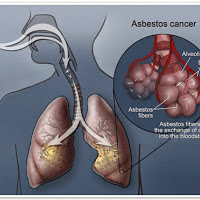 MESOTHELIOMA LAW FIRM