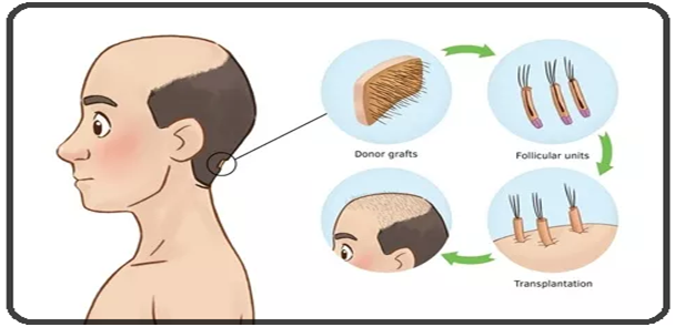 Hair transplant in Navi Mumbai