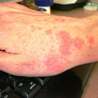 khaj,scabies skin diseases