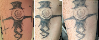 Collage showing laser tattoo removal after one year