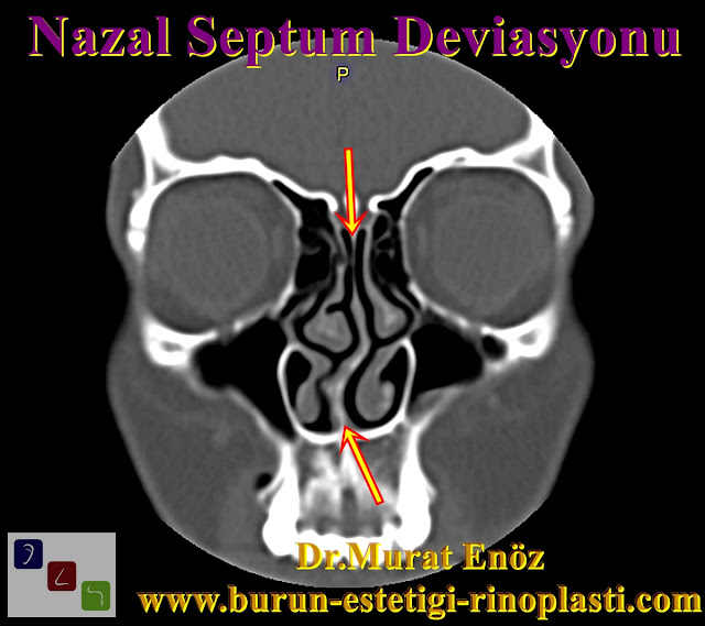 Septum deviasyonu - Burun kıkırdağı eğriliği - Nazal septum deviasyonu nasıl anlaşılır? - Deviasyon ameliyatı - Burun septumu eğriliği - Burun eğriliği