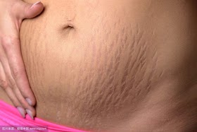 How To Get Rid Of Pregnancy Stretch Marks