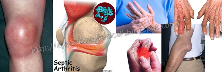 Cara Mengobati Radang Sendi