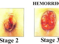 Obat Wasir Tradisional Stadium 3
