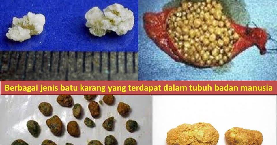 batu karang di buah pinggang