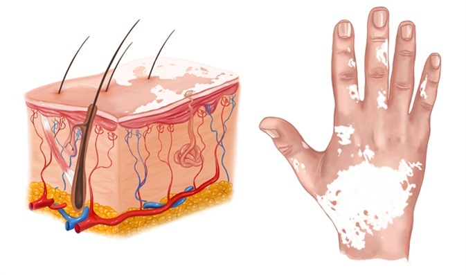 shaklee untuk sopak vitiligo