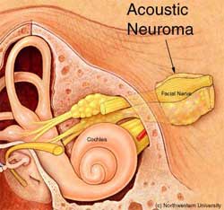 Acoustic Neuroma (Neurolemmoma, Vestibular Schwannoma):Definition,Causes,Symptoms,Diagnosis,Treatment