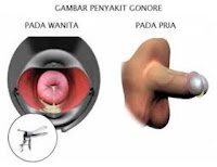 Cara Mengobati Kelamin Keluar Nanah Secara Tiba-Tiba