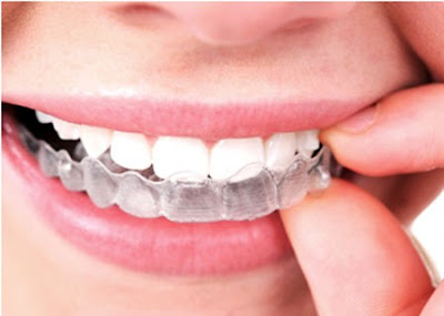 Dịch vụ niềng răng không mắc cài 3D Clear