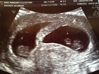 8 week twin ultrasound