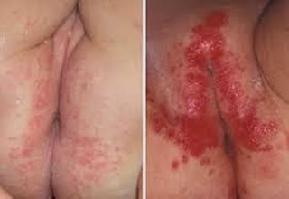 Makalah Penyakit gatal eksim, Obat Penyakit Kulit Atau Eksim, Eksim Menular, Gatal Gatal Di Selangkangan Obatnya Apa, Mengobati Eksim Dengan Salep 88, Hilangkan Gatal Di Kemaluan Lelaki, gatal eksim Dan Psoriasis, Penyakit gatal eksim Pada Orang Dewasa, Cara Mengatasi Eksim Kering, Pengobatan Eksim Basah, Eksim Atau Psoriasis, Bahaya Penyakit Eksim Kering, Cara Mengobati Penyakit gatal eksim Tradisional, Cara Mengobati Eksim Pada Jari Tangan, Obat gatal eksim Tradisional Ampuh, Cara Mengobati Kulit gatal eksim Kering, Jenis Eksim Basah, Daftar Obat gatal eksim Kering, tanda gatal eksim, gatal eksim Pada Kulit Kepala, gatal eksim Spółka Z Ograniczoną Odpowiedzialnością, gatal eksim Kering Bisa Disembuhkan, Salep Untuk Penyakit gatal eksim Basah, Cara Mengatasi Eksim Pada Anak, Eksim Leher, Mengatasi Penyakit gatal eksim, Tanaman Obat Untuk Penyakit Eksim, Salep Untuk Penyakit gatal eksim Basah 