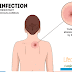 How to Cure a MRSA Infection Naturally