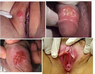 Penyakit Herpes Pada Kelamin Pria