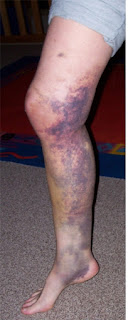 my leg after coming off the motorbike in 2007 - looks worse than it feels