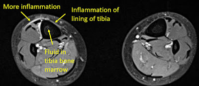 Inflammation