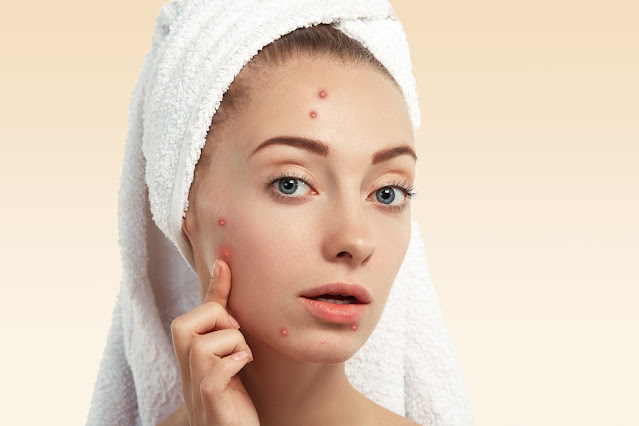 how to remove pimple marks naturally at home