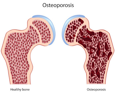 Obat Ramuan Tradisional Osteoporosis Yang Ampuh