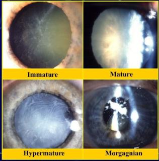 symptoms of cataract,motiyabind,motibindu operation cost
