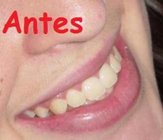 Dentes amarelados - foto modelo