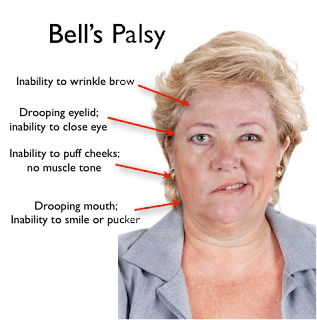 Bell Palsy