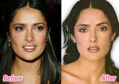 celebrity plastic surgery