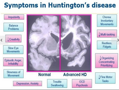 Huntington's Disease Pictures