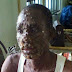 Monkey pox hits Lagos