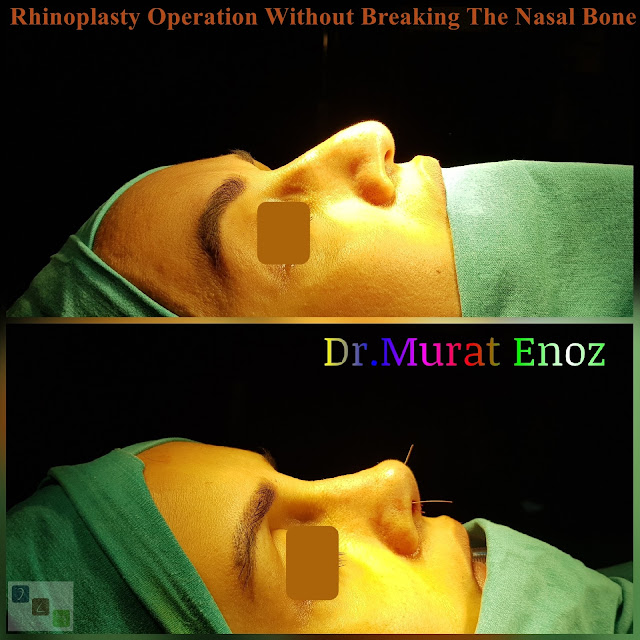 Nose job without bone broken,Rhinoplasty Without Breaking The Nasal Bone in Istanbul,